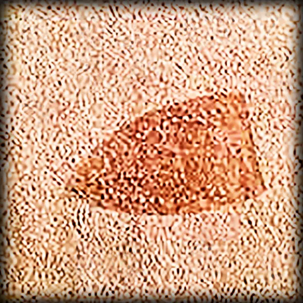burn removal
